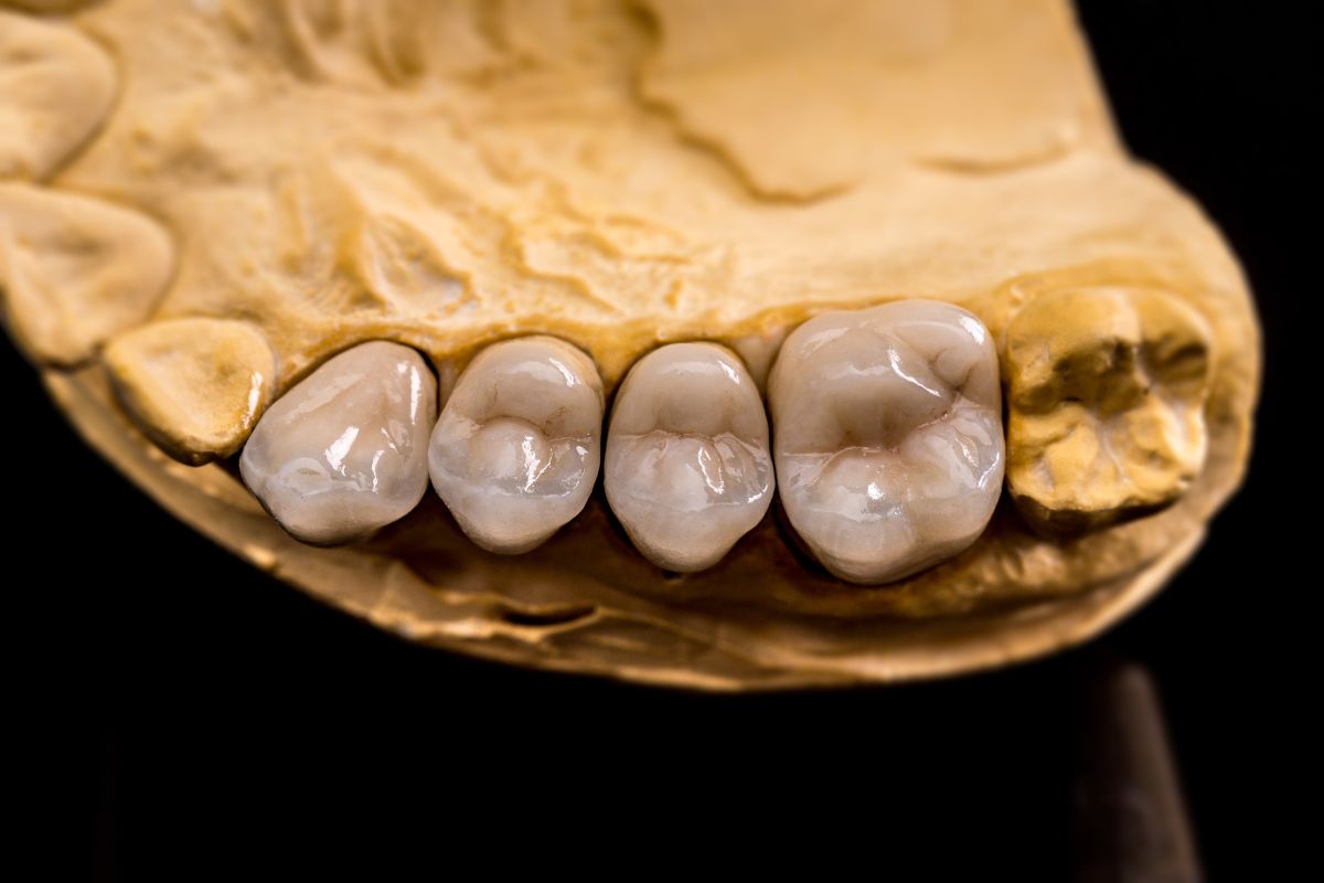 dental crowns in beaverton