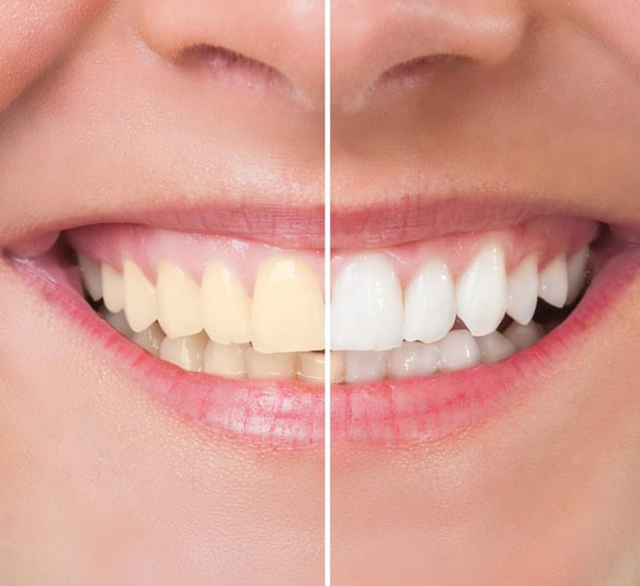 Teeth Whitening in Beaverton