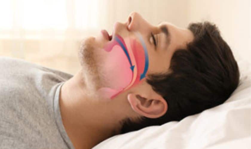 Sleep Apnea in Beaverton