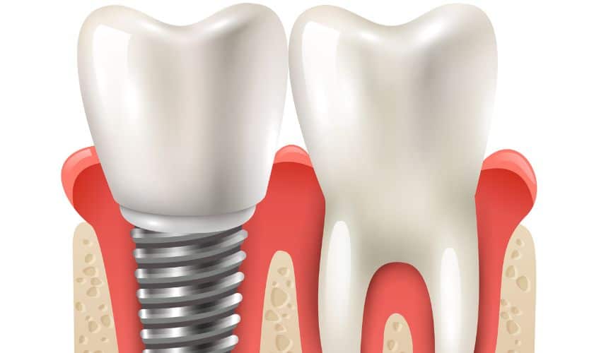 Dental implants in Beaverton, OR
