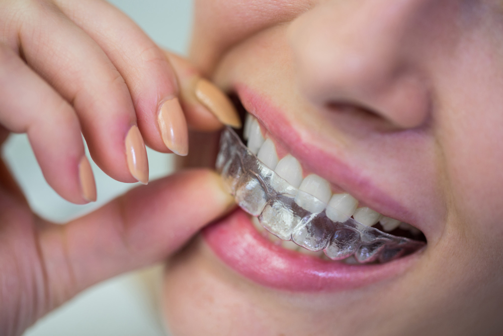 Invisalign in Beaverton