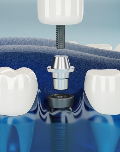 Dental implant model showing crown, abutment, and fixture components on blue background.