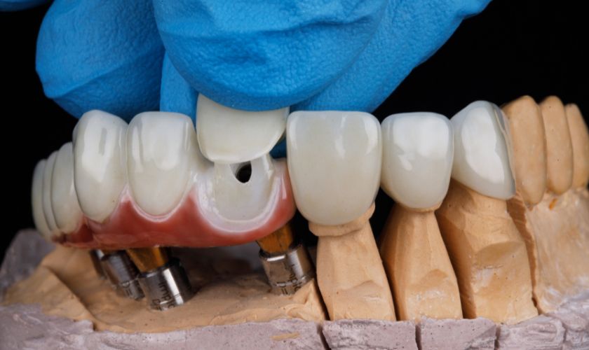 Featured image for “Exploring Your Choices: Three Types of Dental Crowns”