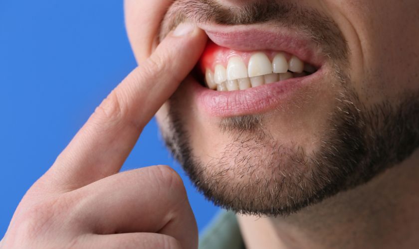 Featured image for “Gum Recession: Causes, Treatments, and Maintaining a Healthy Smile”