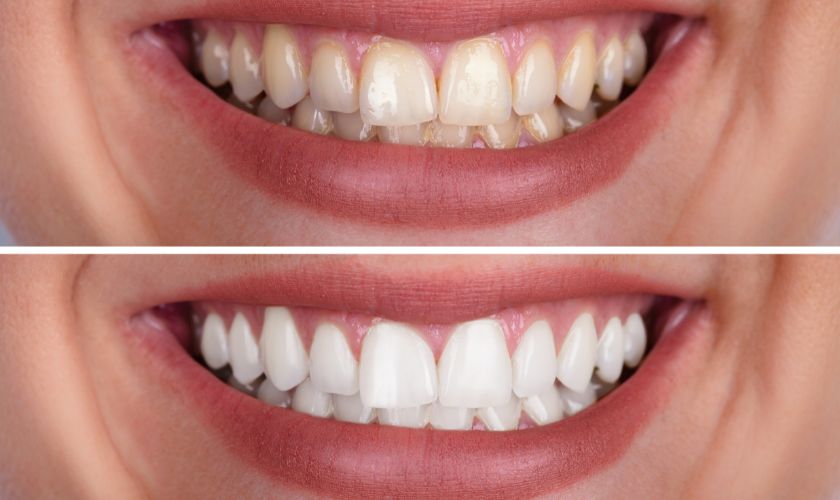 Featured image for “What is the Best Method to Whiten Teeth?”