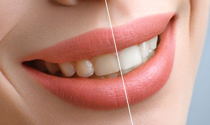 Teeth Whitening Beaverton