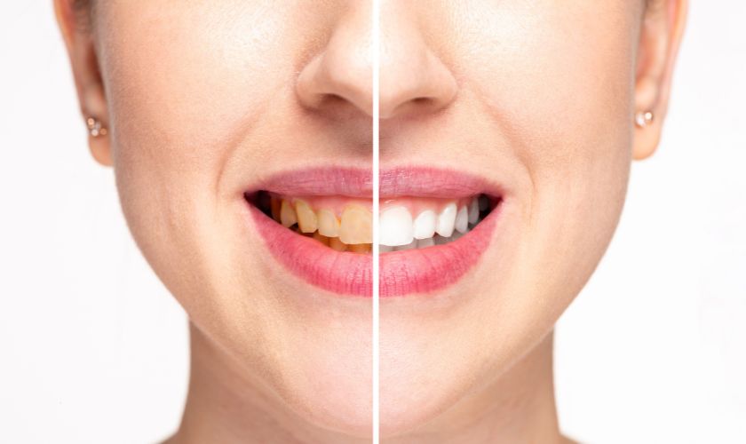 Teeth Whitening Beaverton