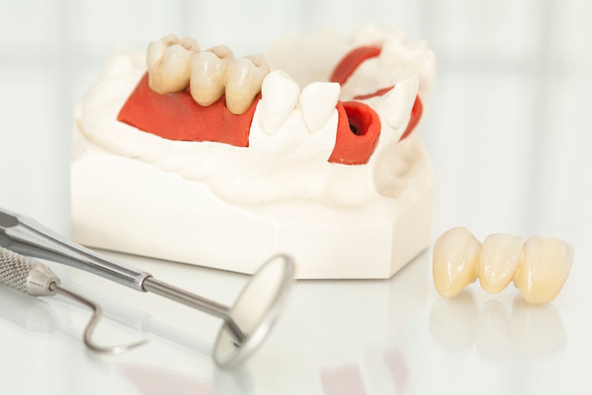 Dental Crowns in Beaverton