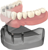 Dental implant model showing prosthetic teeth placement on jawbone structure for patient education.