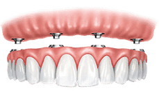 Dental implant prosthetic showing gum structure and artificial teeth restoration model.