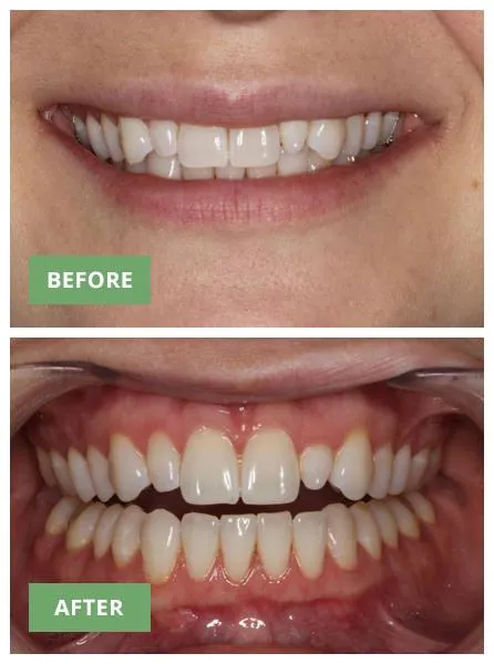 Before and after dental treatment comparison showing improved smile alignment and teeth whitening results.