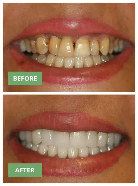 Before and after dental whitening comparison showing yellowed teeth transformed to bright white teeth.