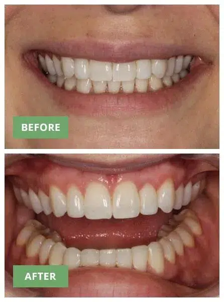 Before and after dental treatment showing improved tooth alignment and whiteness at Murray Scholls Family Dental.