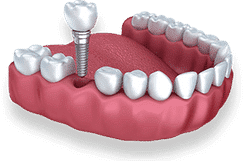 Dental implant model showing tooth replacement procedure on artificial gum structure with prosthetic tooth and screw.