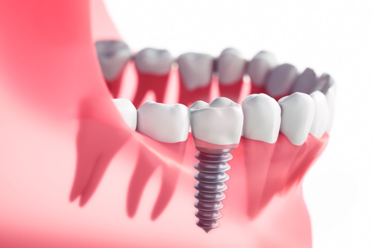 dental implant in beaverton