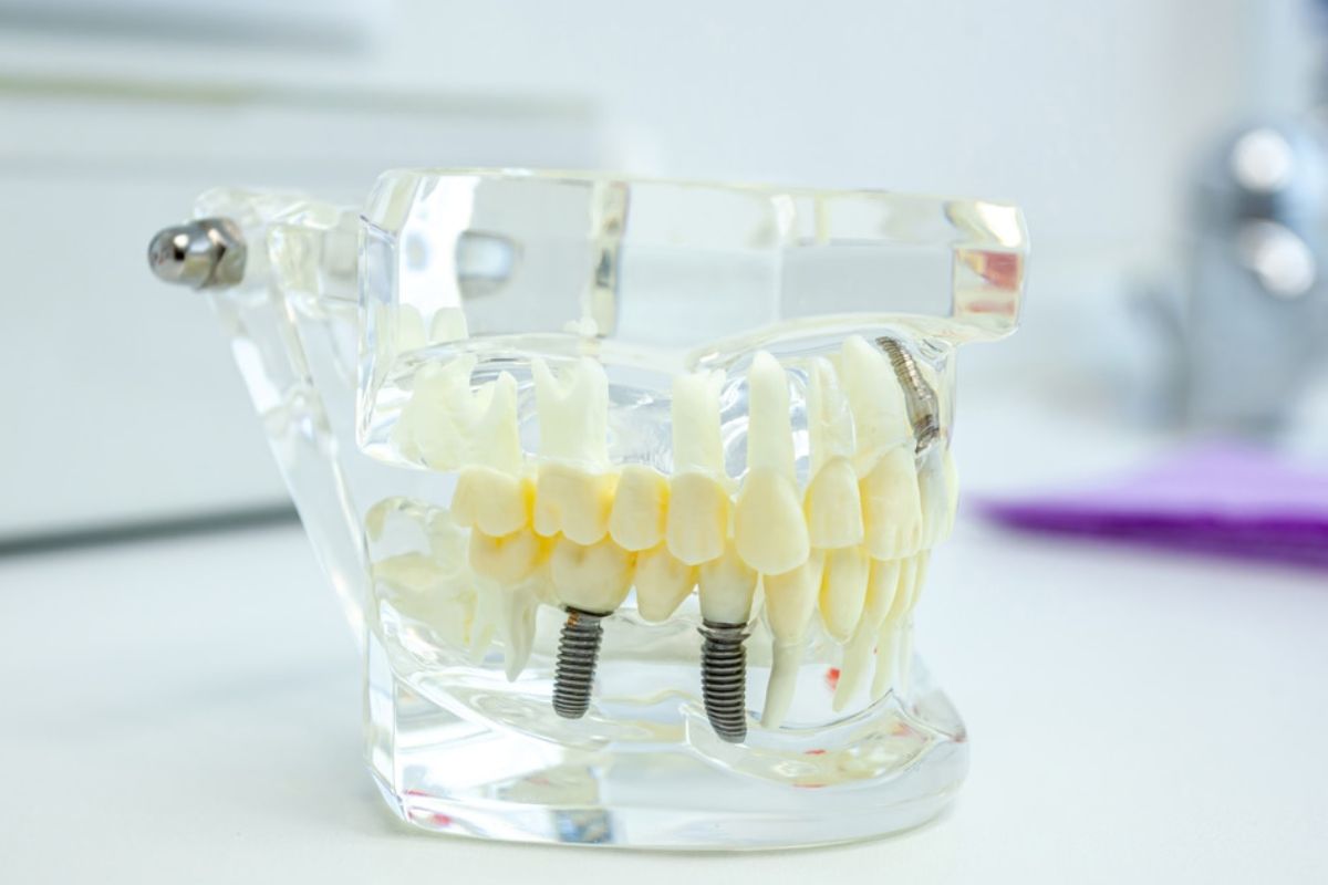 dental implant in beaverton