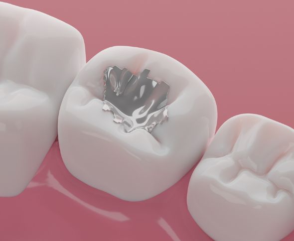 Dental Composite Fillings