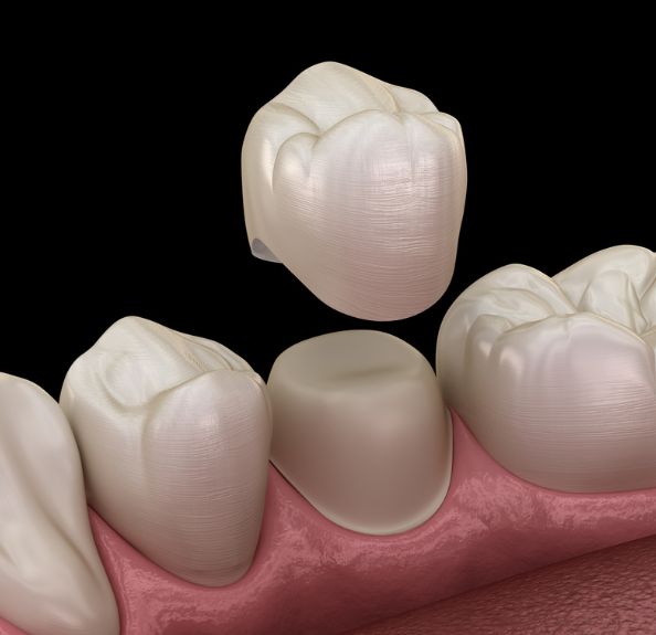 dental crowns in beaverton