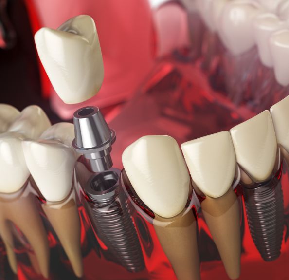 dental implant in beaverton