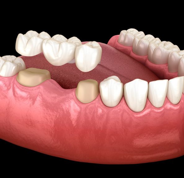 dental crowns beaverton
