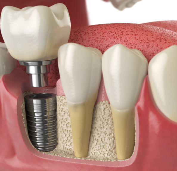 dental implant procedure