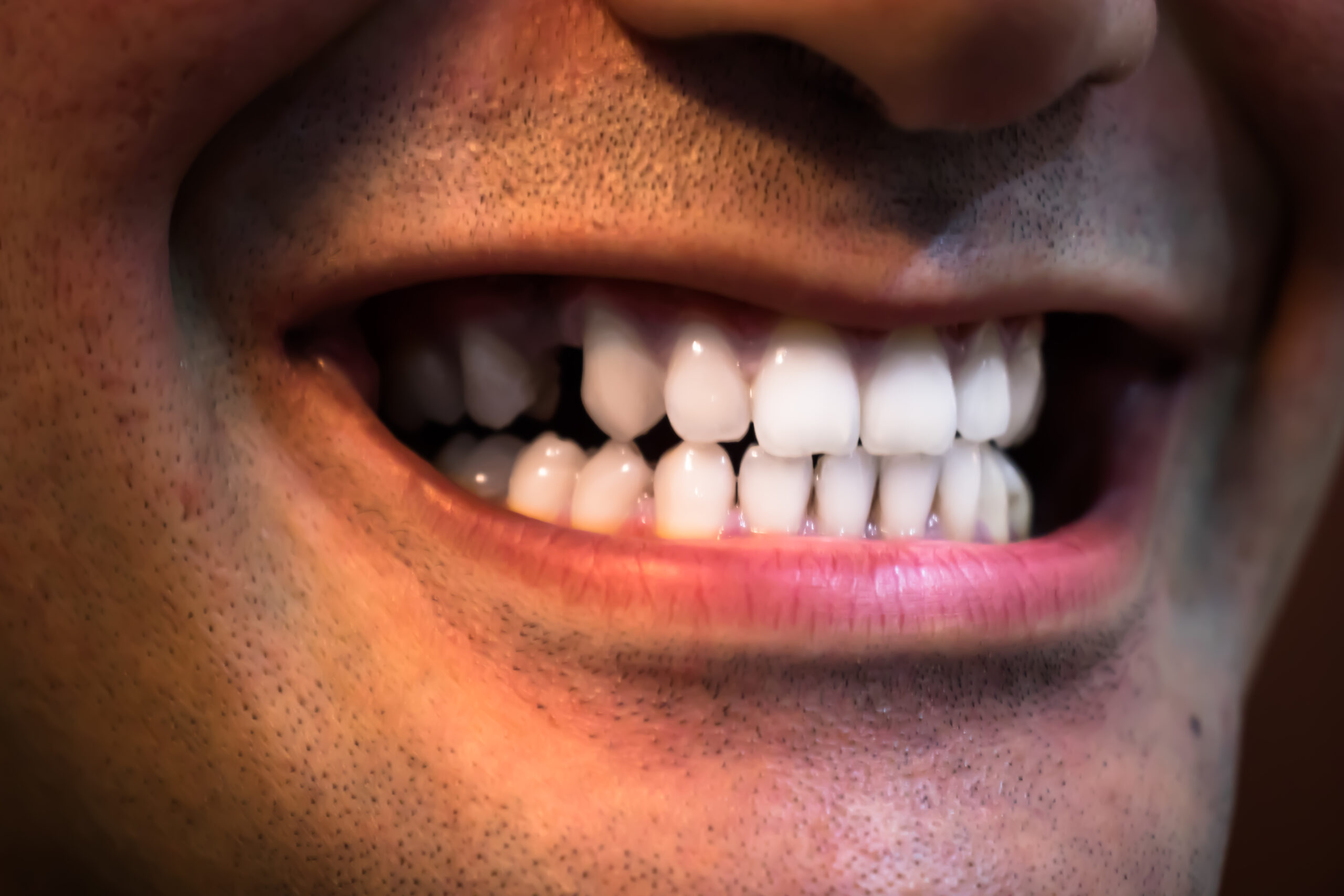 Close-up of a smile showing straight white teeth with a visible missing tooth