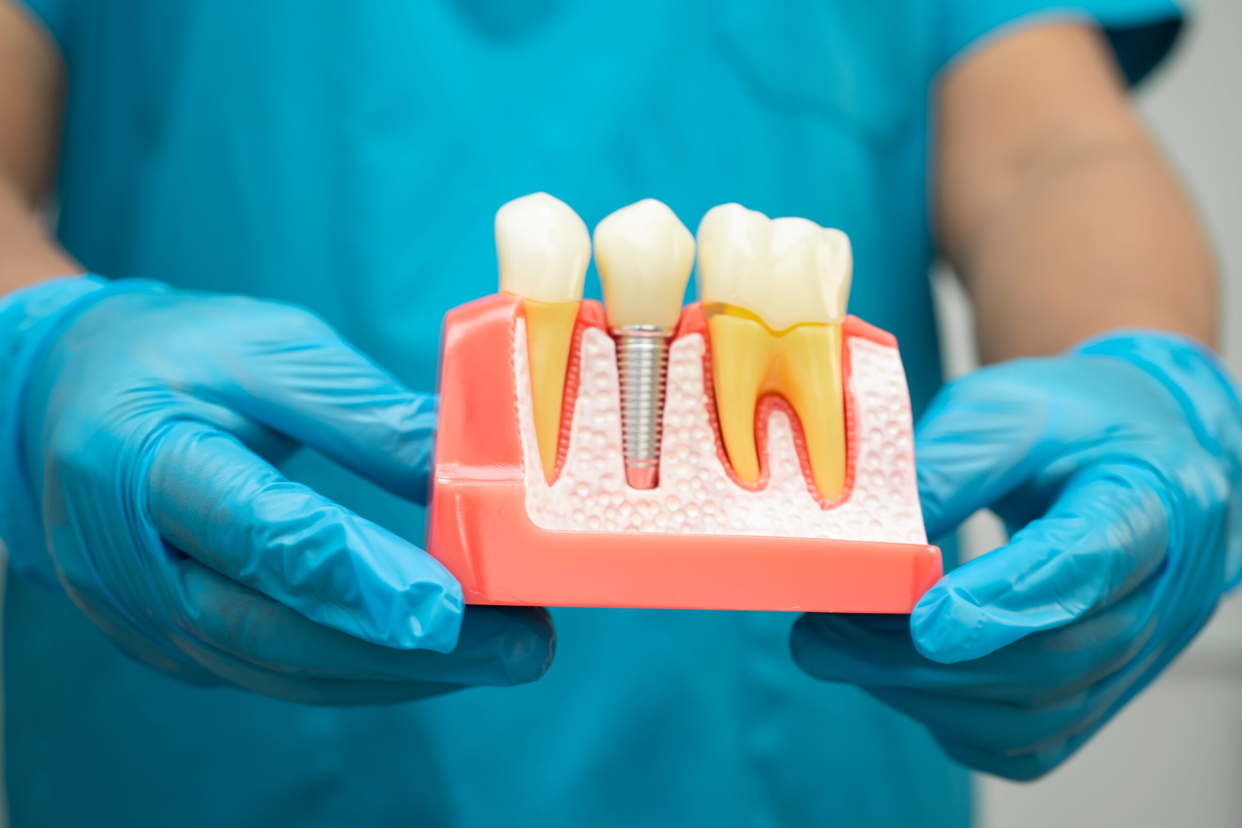 Dental professional holding a model showing a dental implant placed in the jawbone to restore a missing tooth