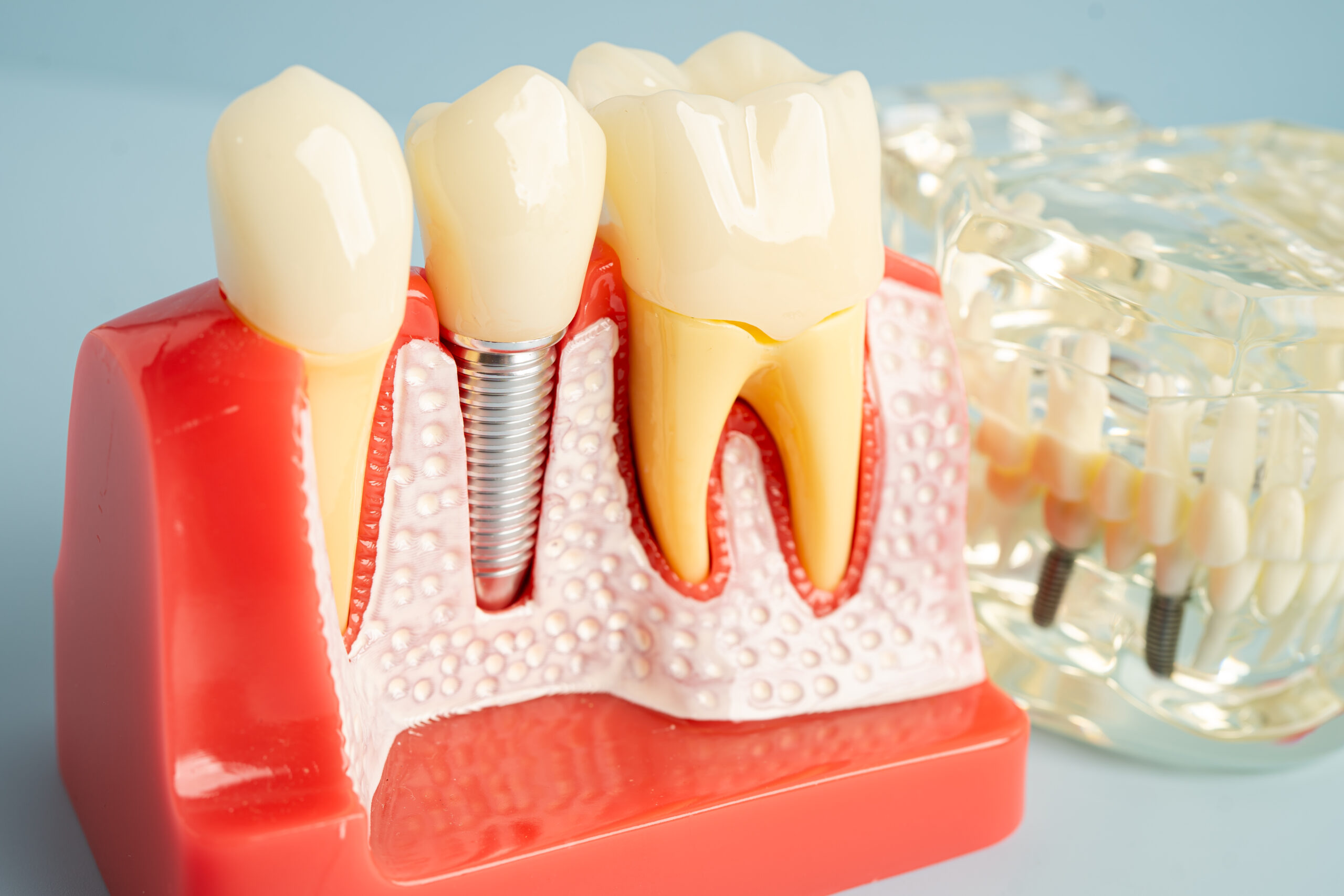 Dental implant model showing titanium post placed in jawbone with crown attached next to natural tooth