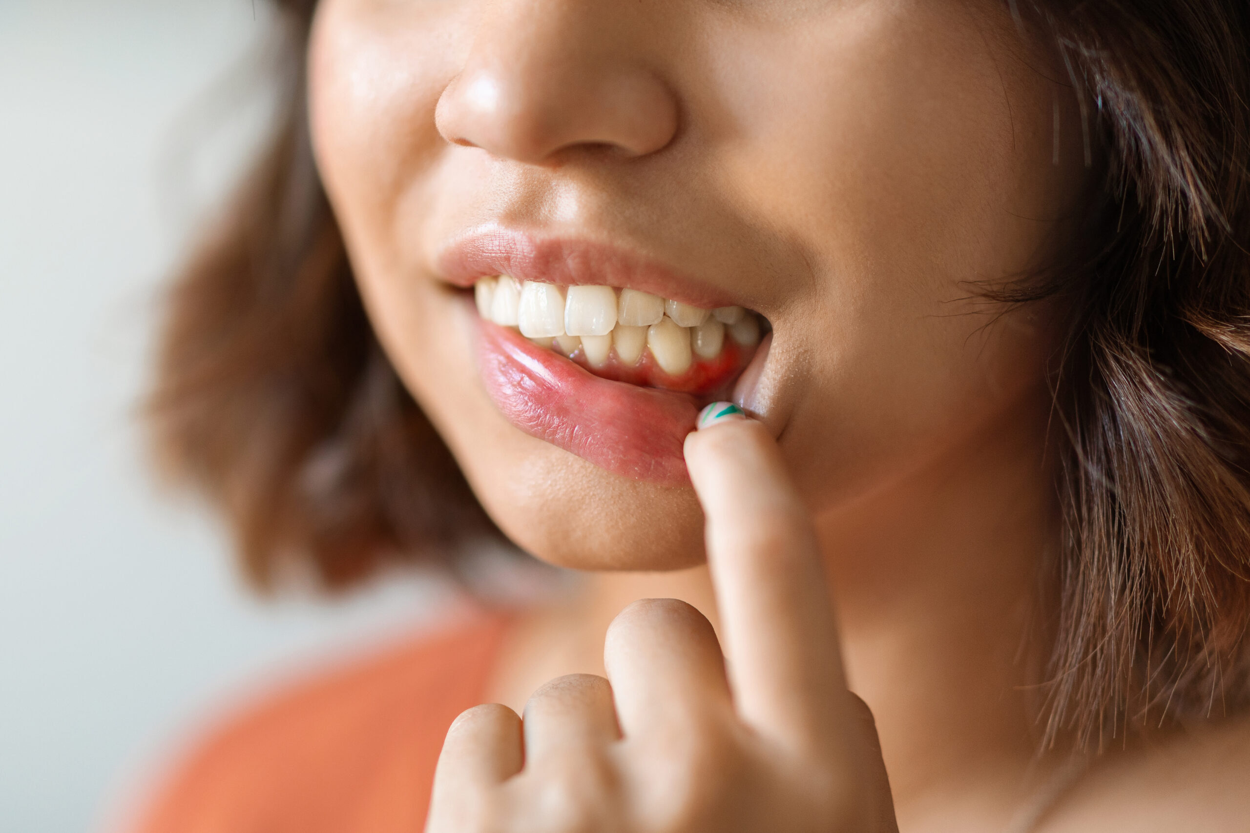 Woman pulling down her lower lip to show a white sore on her gum near the back teeth