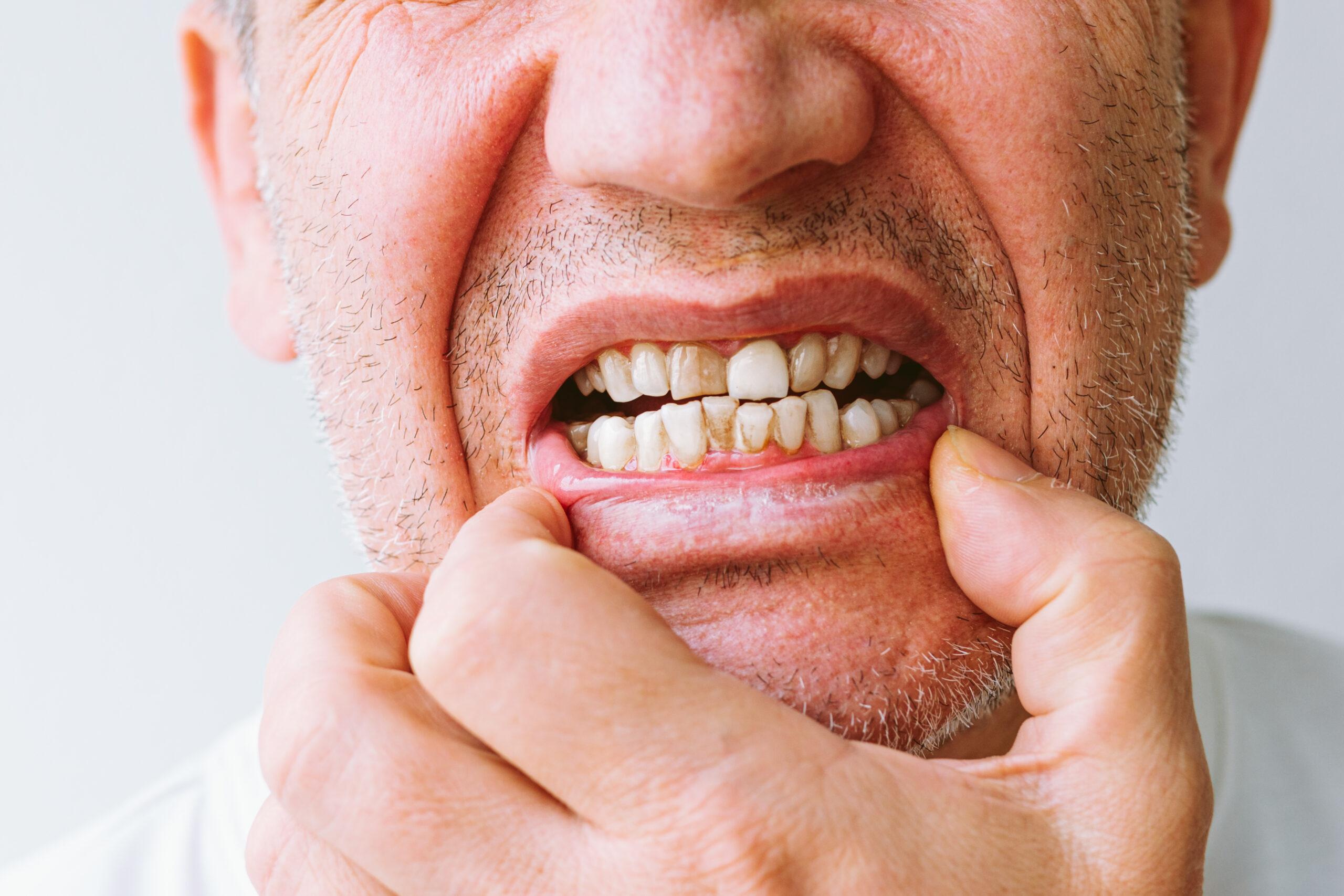 Featured image for “What Causes Dark Spots on Teeth and How Can a Cosmetic Dentist Fix Them?”