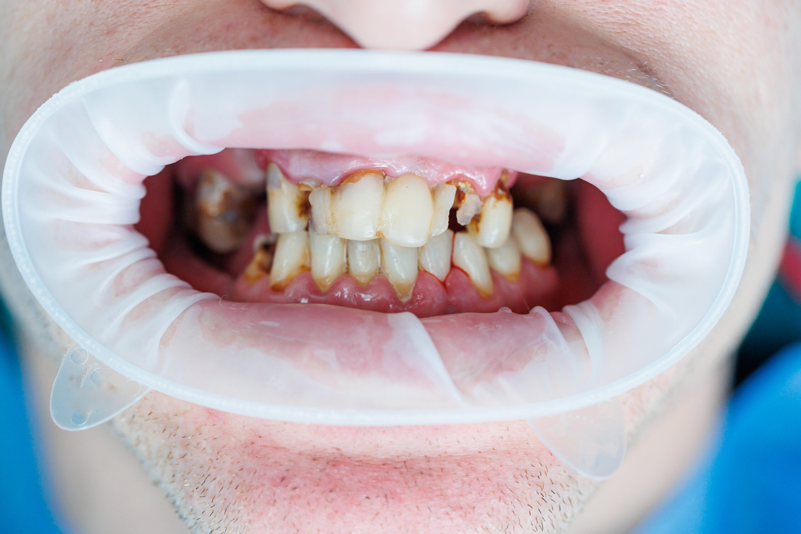 Featured image for “Can a Restorative Dentist Save a Badly Damaged Tooth?”