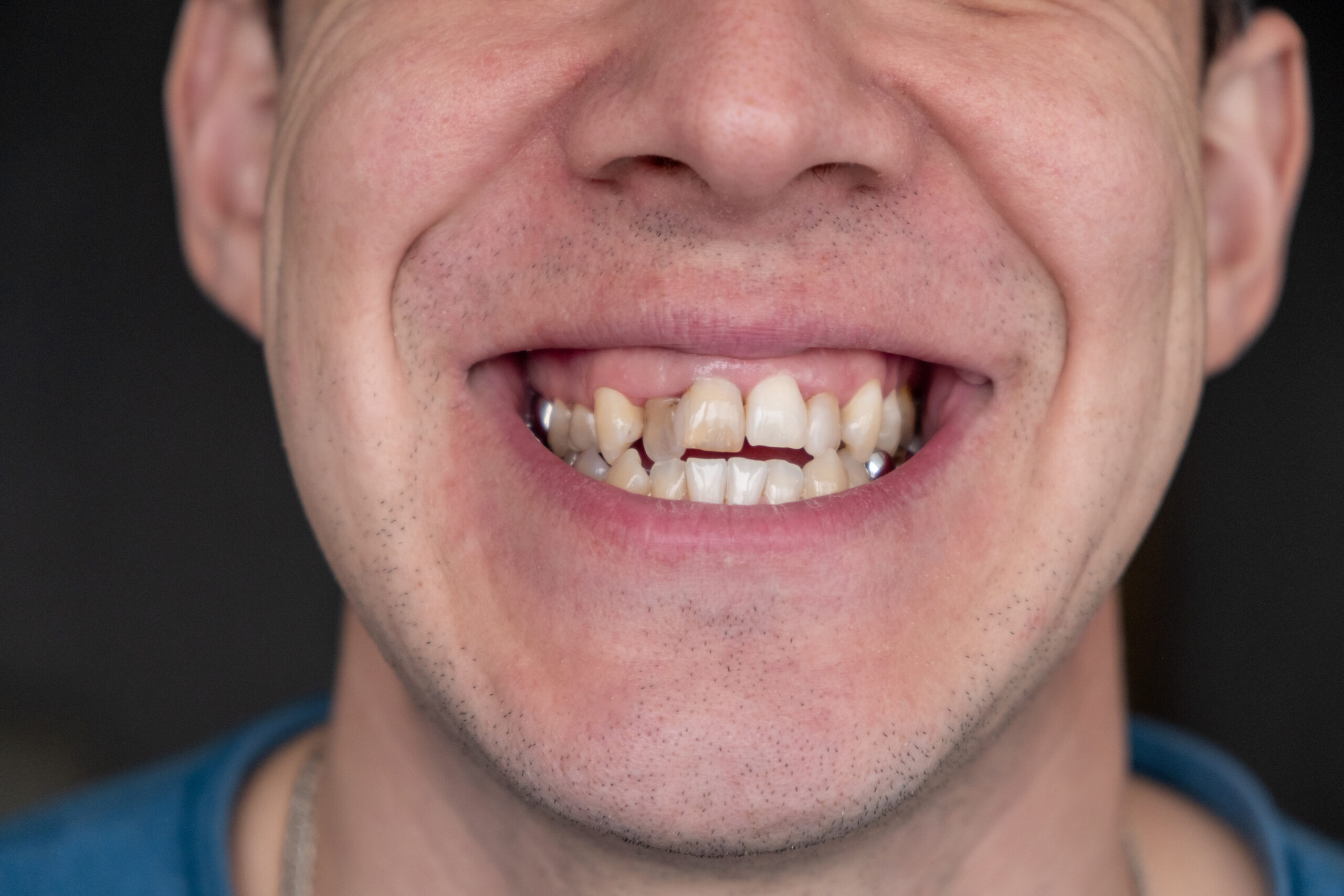 Featured image for “Battling Insecurity from Worn-Down Edges on My Teeth”