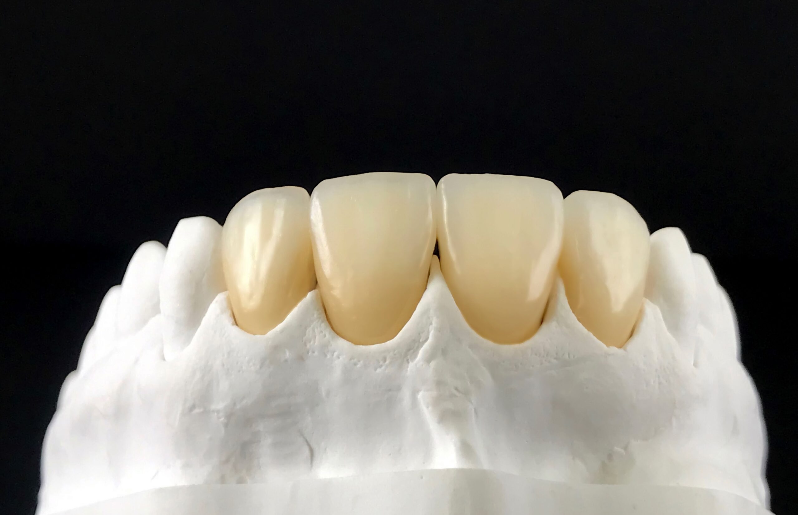 Featured image for “The Dental Crown Procedure, Step by Step: A Patient’s Complete Guide”