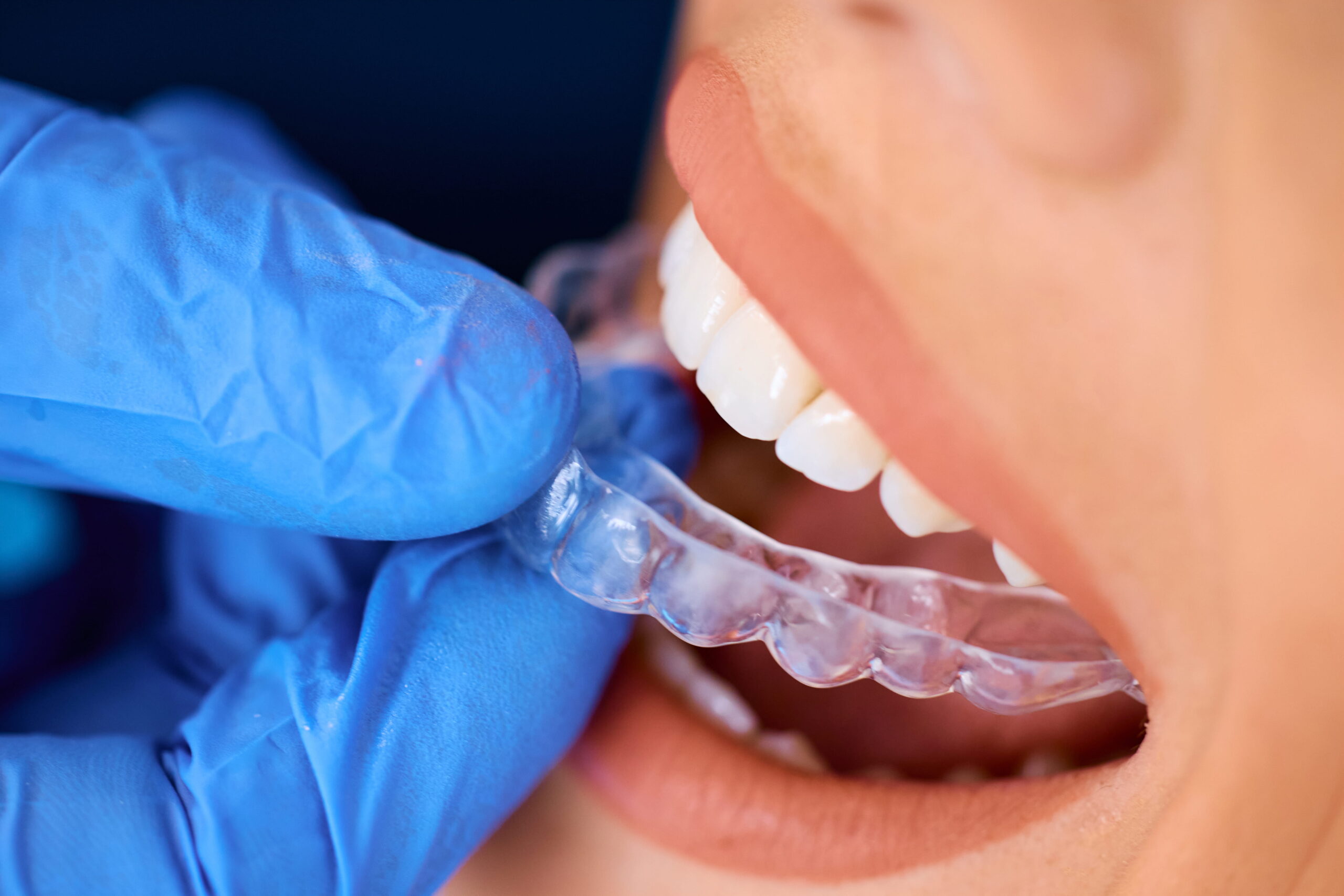 Featured image for “Invisalign for Teens: What Every Parent Should Know Before Getting Started”